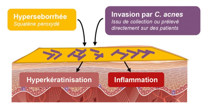 site-industries-cosmetiques Un modèle 3D simulant une peau à tendance acnéique illustrant les étapes de l'hyperpigmentation.