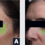 site-industries-cosmetiques Photos côte à côte du visage d'une femme avec une barre noire sur les yeux et des marques vertes sous les yeux dans un contour bleu. L'image de gauche est étiquetée "A" et celle de droite "B", démontrant l'impact de la technologie BIODIS+ sur la santé de la peau.