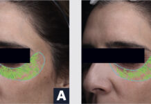 site-industries-cosmetiques Photos côte à côte du visage d'une femme avec une barre noire sur les yeux et des marques vertes sous les yeux dans un contour bleu. L'image de gauche est étiquetée "A" et celle de droite "B", démontrant l'impact de la technologie BIODIS+ sur la santé de la peau.