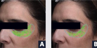 site-industries-cosmetiques Photos côte à côte du visage d'une femme avec une barre noire sur les yeux et des marques vertes sous les yeux dans un contour bleu. L'image de gauche est étiquetée "A" et celle de droite "B", démontrant l'impact de la technologie BIODIS+ sur la santé de la peau.